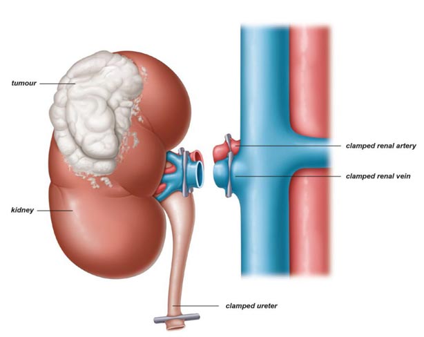 right-nephrectomy-tirath-ram-shah-hospital